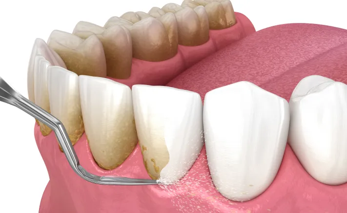 Scaling & Root Planing at McQuiston Dental in Alexandria, Virginia