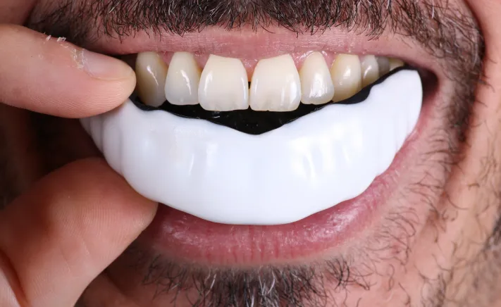 Sports Mouth Guards at McQuiston Dental in Alexandria, Virginia