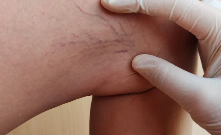 Vascupen at McQuiston Dental in Alexandria, Virginia